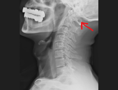 The Mystery of the Arcuate Foramen: A Special Bone in Your Neck